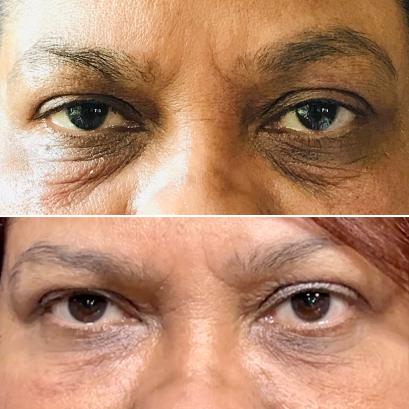 Neotensil before and after  Under eye wrinkles Under eye bags Eye bags
