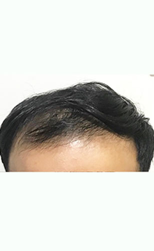 Before-3