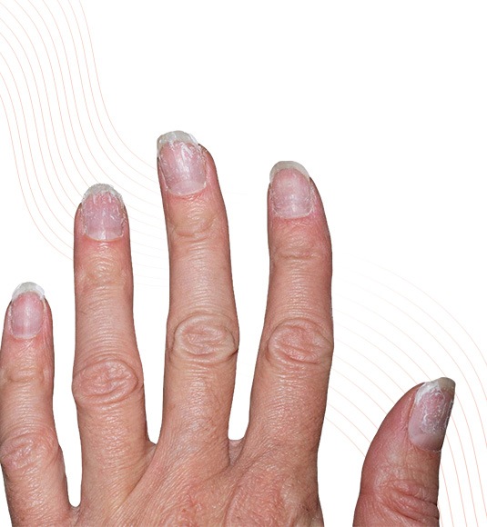 Nail Conditions