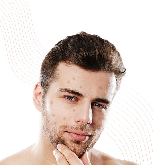 Pigmentation-Melasma-Removal