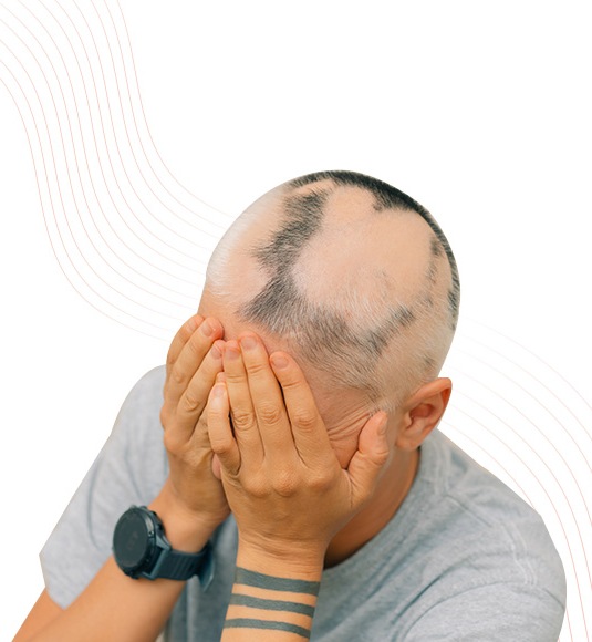 Scarring Alopecias