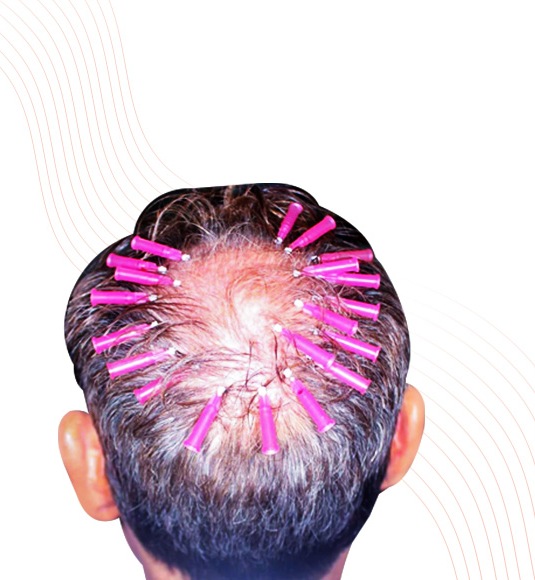 Threads for Scalp