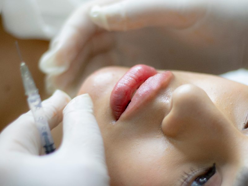 Lip Fillers