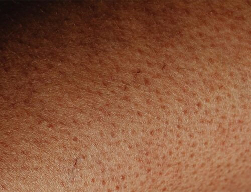 Eczema and Dermatitis — Managing Flares in the Indian Climate