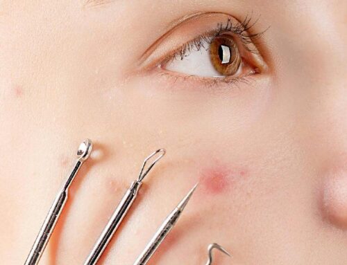 Microneedling — Myths, Facts, and What to Expect