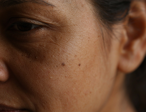 How Heat Speeds Up Skin Ageing and What You Can Do