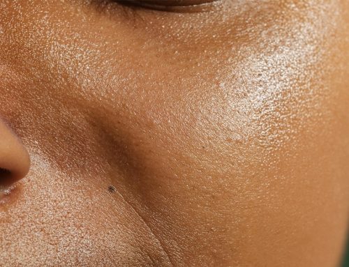 Sebaceous Cysts — What They Are and When to Remove Them