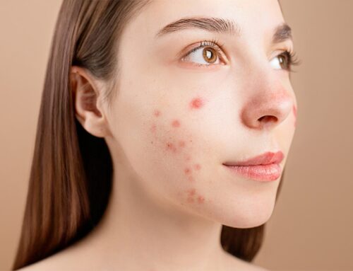 Skin Purging vs Breakout — How to Tell the Difference