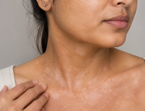 Everything You Need to Know About Tinea Versicolor