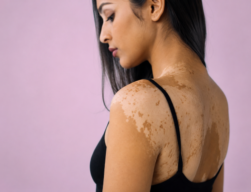 How to Remove White Patches on Face: Causes & Treatments