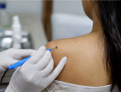 Advanced Wart & Mole Removal by Dermatologists