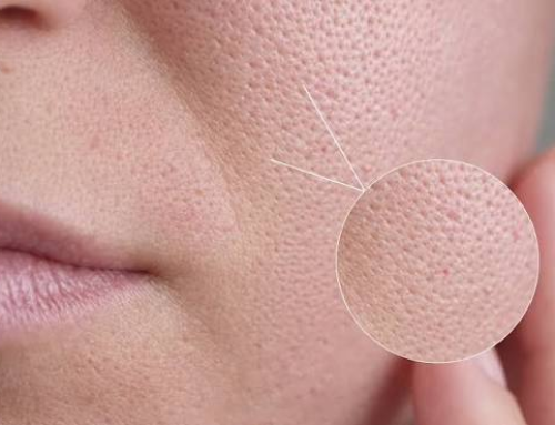 Open Pores: Causes, Treatments, and Prevention